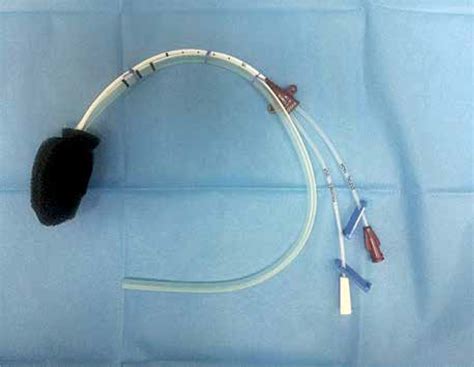 Endoscopic Vacuum Therapy With Instillation Ievt A Novel Endoscopic