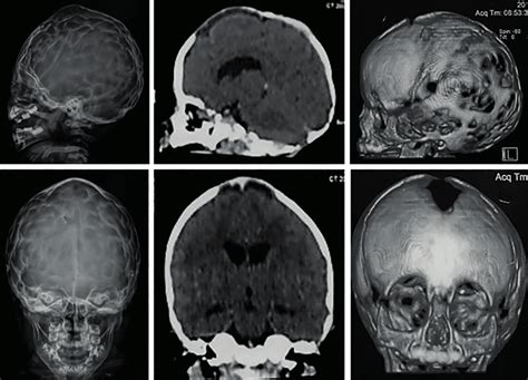 Skull Images At The Age Of Year And Months A B Radiographs