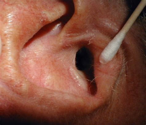 Exostosis - of Foot, Mouth, Ear, Definition, Pictures | HubPages