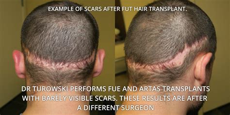 FUE Hair Transplantation Before And After Pictures Dr Turowski