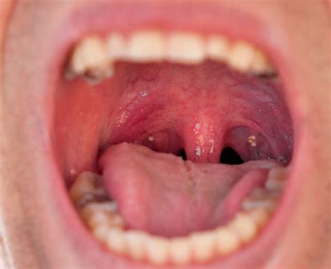 Tonsil Stones Symptoms Causes Removal And Treatment
