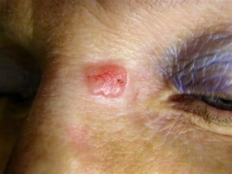 Basal Cell Carcinoma Dr Vindy Ghura Dermatologist Manchester