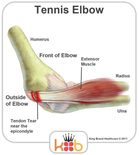 Related online courses on physioplus. Tennis Elbow and Outer Elbow Pain — Body & Brain Centre