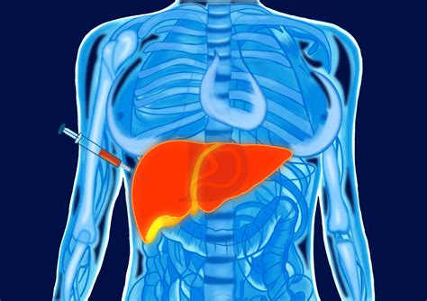 Learn About The Liver Biopsy And Its Procedure The Gi Docs