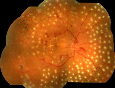 Diabetic Retinopathy With Laser Photocoagulation Retina Image Bank