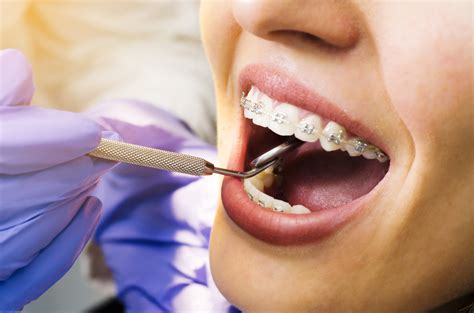 Dental Braces Treatment Details Removal And Recovery