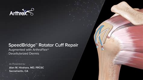 Arthrex Speedbridge™ Rotator Cuff Repair Augmented With Arthroflex