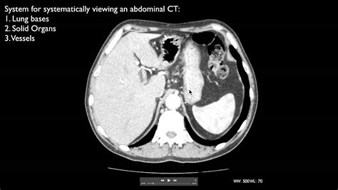 How To Interpret An Abdominal Ct Youtube
