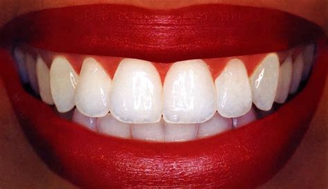 Stirway To Heaven 12 Natural Home Remedies For Teeth Whitening