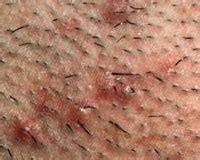 Removal for ingrown hair using coconut oil, tea tree oil or salicylic acid. Suffering from ingrown hair? Vitality Spa Offers Laser ...