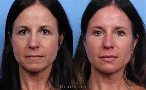 Beautiful Results And Makeovers • Rejuvent Medical Spa Scottsdale