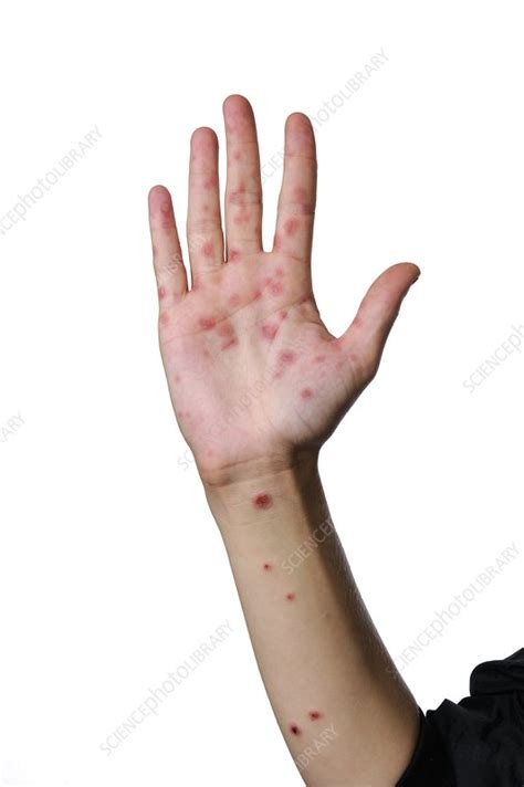 Erythema Multiforme Rash On Hand Stock Image C0115512 Science