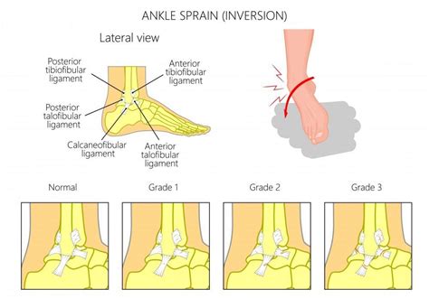 What Is An Ankle Sprain Eugene Stautberg Md General Orthopedic Surgeon