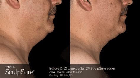 Sculpsure Before And After Gallery John Macey Md