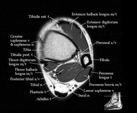 However, on mri images, no muscular abnormalities were detected. Muscle Anatomy Of Foot Radiology - Musculature | Radiology Key / Medial side of base of proximal ...