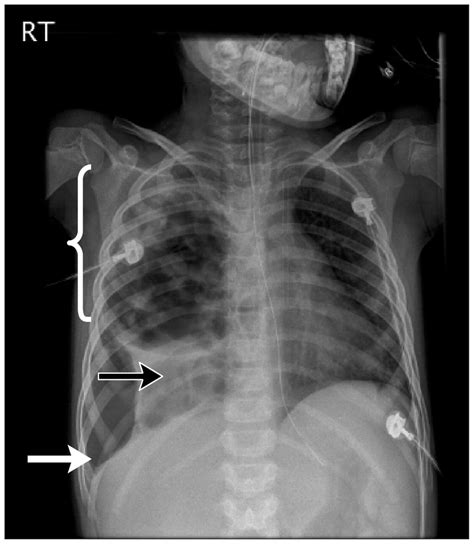 Severe Necrotizing Pneumonia In A Child With Pandemic H1n1 Influenza