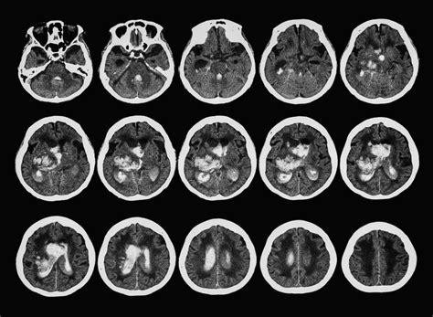 The Role Of Ct And Mr In Stroke Patients