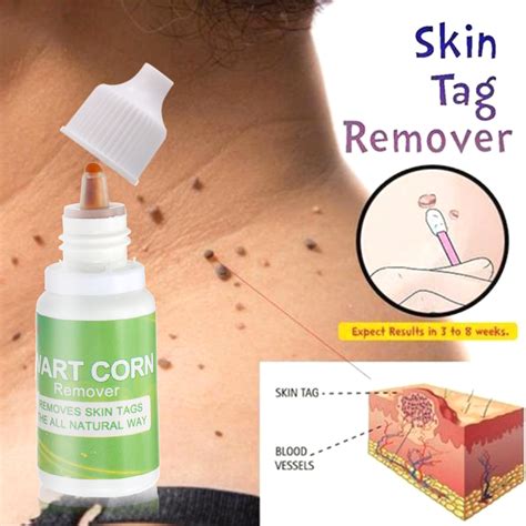 Acrochorda), is a small benign tumor that forms primarily in areas where the skin forms creases (or rubs together), such as the neck, armpit and groin. 10ml Skin Tags Remover with Cotton Swab Skin Tags Mole ...