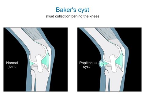 8 Best Ways To Treat Bakers Cyst Rocketfacts