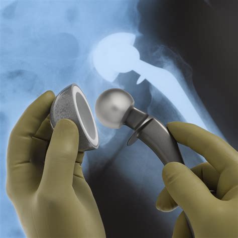 How A Hip Replacement Surgery Is Performed