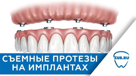 Съемные протезы на имплантах - YouTube