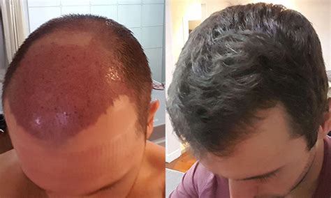 Getting thicker hair in a month is possible, but it does take some work. My FUT Hair Transplant: The First 5 Months | Finch Sells