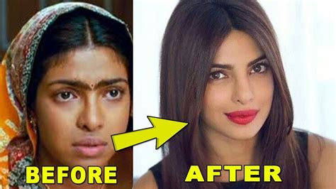 Priyanka Chopra Plastic Surgery Photos Before And After Priyanka Chopra Plastic Surgery Video