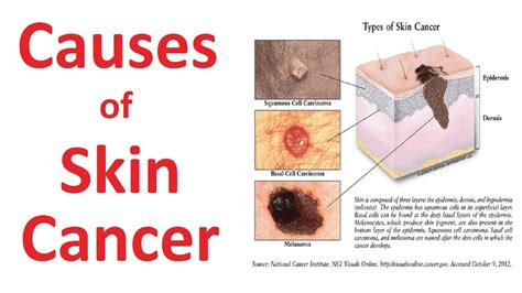 Skin Cancer Surgery In Aligarh Skin Hair Expert