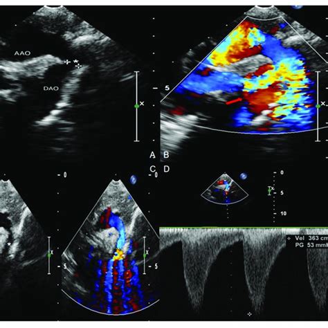 Echocardiogram With Color Doppler Flow Imaging Showing Coarctation Of