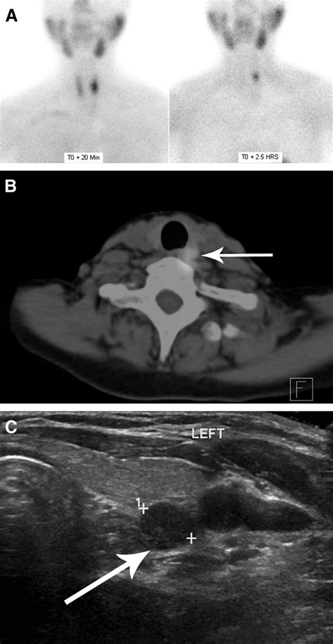 Spectct Guided Ultrasound For Parathyroid Adenoma Localization A 1