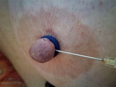 Nipple Injection Telegraph