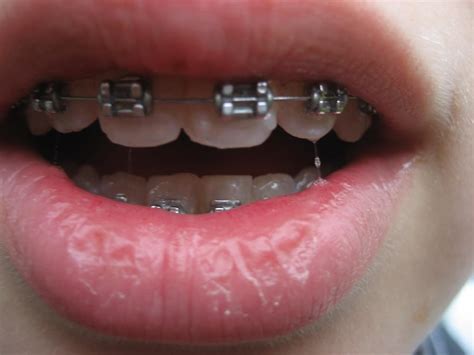 How to fix gaps & spaces in teeth. How To Fix Crooked Teeth Without Braces At Home - Homemade ...
