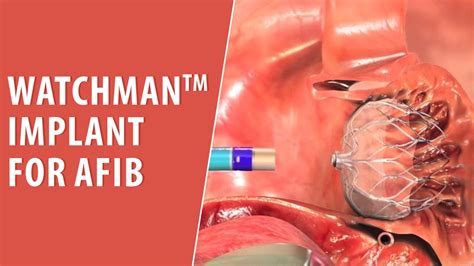 WatchmanImplant For AFib Texas Cardiac Arrhythmia Trusted Patient Education Platform