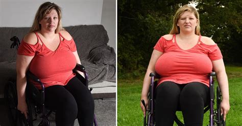 Womans Massive 42i Breasts Left Her Wheelchair Bound Small Joys