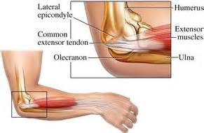 Your forearm muscles, which attach to the outside of your elbow, may become sore from excessive strain. Tennis Elbow. Everything You Need To Know. - What is ...