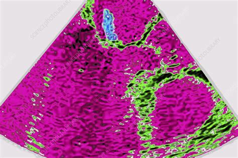 Endocarditis Echocardiography Stock Image C0556099 Science