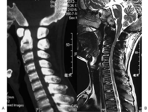 Preoperative Ct And Mri Of The Cervical Spine A Preoperative Ct