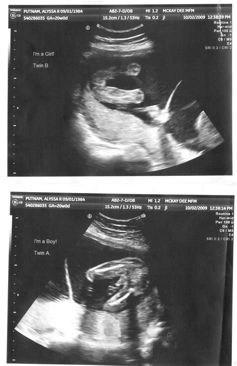 Tyler And Lissy 20 Week Ultrasound Pics