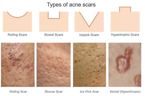 Acne Scars Types Of Acne Scarring And Ideal Treatments