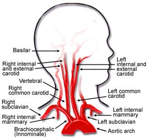 See full list on mayoclinic.org CAROTID ARTERY DISEASE | Surgical Specialists of Southwest Florida