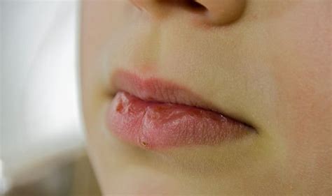 Vitamin B12 Deficiency Symptoms Chapped Lips Could Be A Sign Your Diet
