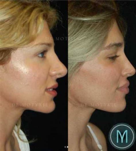 29 Year Old Female Treated With Facial Fat Transfer Pic By Dr Gary