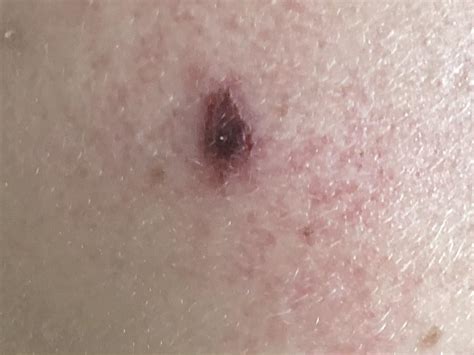 Should I Get This Checked Out Rmelanoma