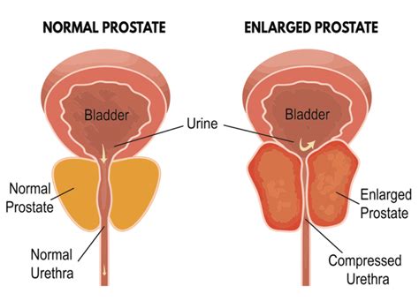 Prostata Ingrossata Quali Rimedi Cura Dei Denti Benessere E Altro