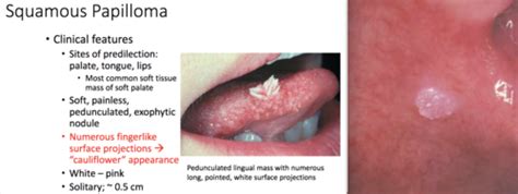 Squamous Papilloma Tongue