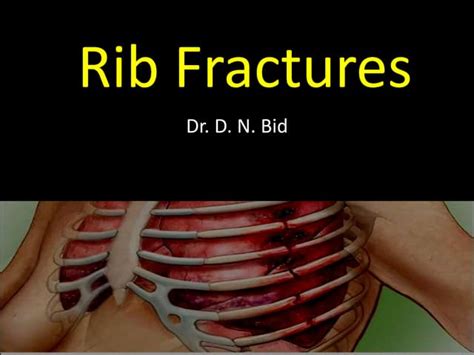Rib Fracture And Costochondral Separation