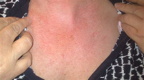Rashes On Face Neck And Chest Pictures Photos