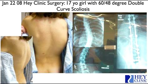 Dr Lloyd Heys Blog Scoliosis And Spine Care Aviation Safety And Quality Standard Work Can