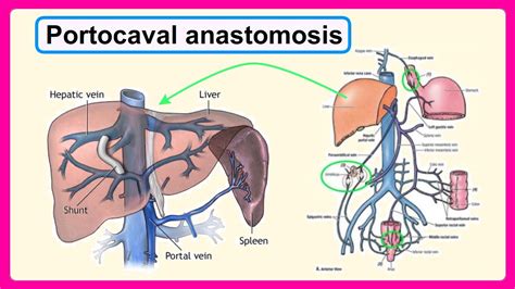 Portocaval Anastomosis Youtube