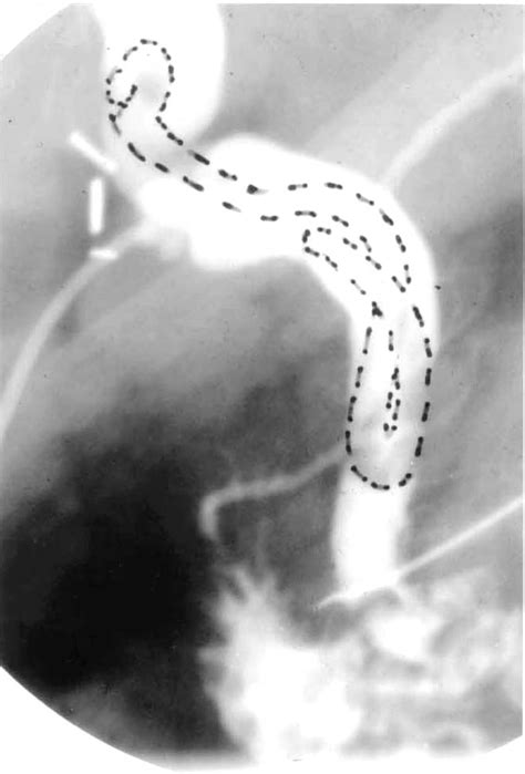 Cholangiogram Demonstrating An Ascaris Causing Obstruction And